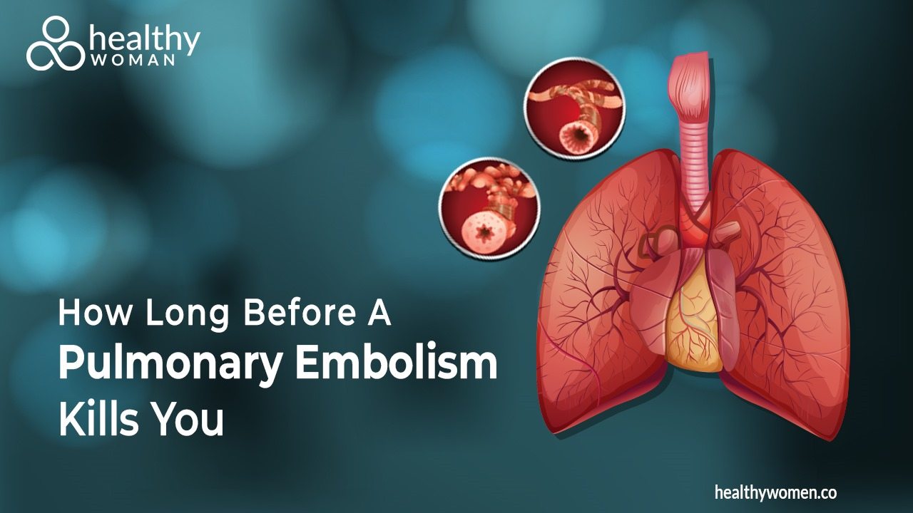 How Long Before A Pulmonary Embolism Kills You? Make Everyday Count